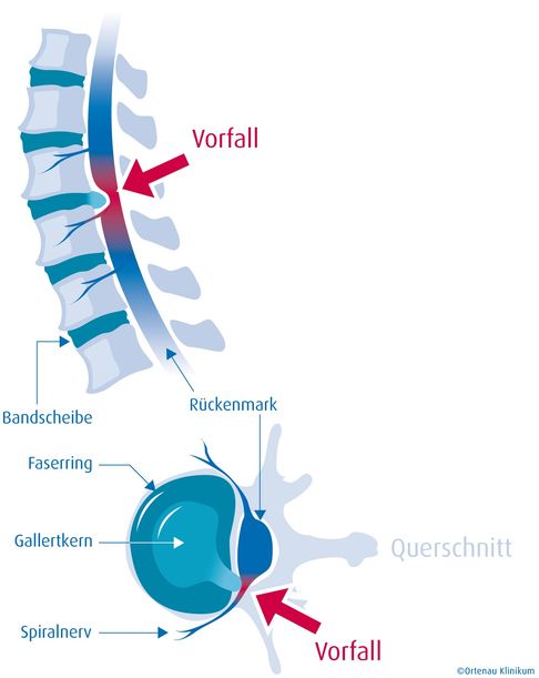 Arbeitsblatt - Der Bandscheibenvorfall - Biologie - Mittlere Reife ...